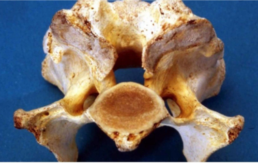 Cervical Spondylomyelopathy - Exploring the Diagnosis and Complexities of Wobbler Disease